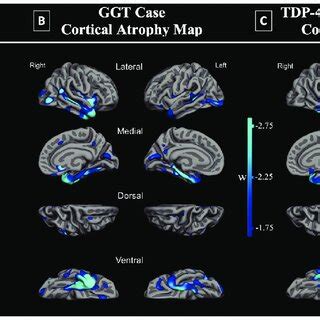 Imaging findings in GGT case and comparison to TDP. A. Patient's T2 ...