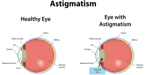 What is Astigmatism - Causes, Symptoms,Treatment