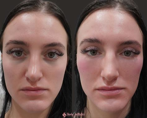 Juvederm Fillers - Benefits, Costs, Results & Procedure Steps