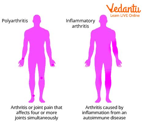 Polyarthritis - Definition, Symptoms, Causes and Key Features