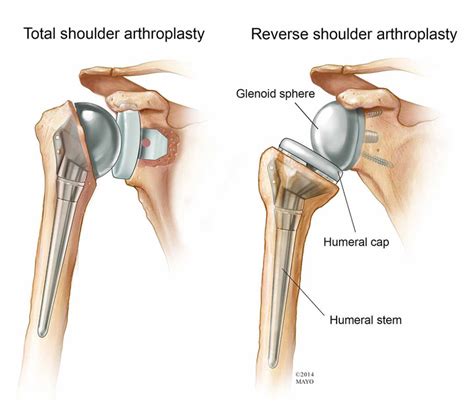 How Long Does Shoulder Replacement Recovery Takes?