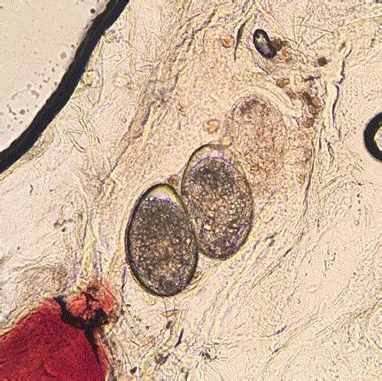 Scabies Eggs Under Microscope