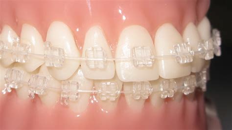 Clear Ceramic Braces in Houston sugar land | iSmile Specialists