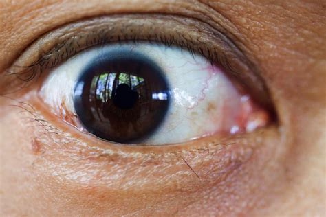 10 Signs of Cataracts - Facty Health