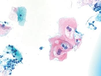 Cytopathology in Focus: The evolving management of LSIL in Pap tests ...