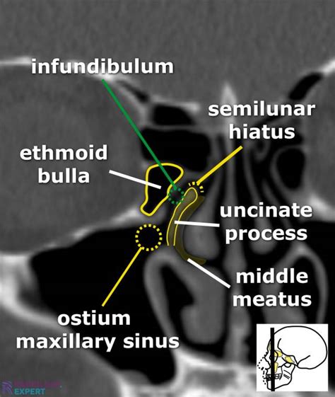 CT sinus