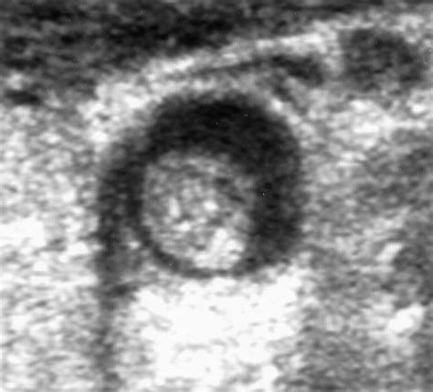 Ultrasound Finding of a Mobile Atheroma in the Common Carotid Artery ...