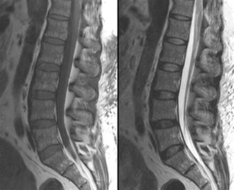 Lumbar Spine Mri Labeled