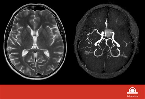 MRA vs. MRI - Brain Aneurysm Foundation