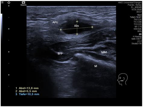 Submandibular Gland Stone Ultrasound