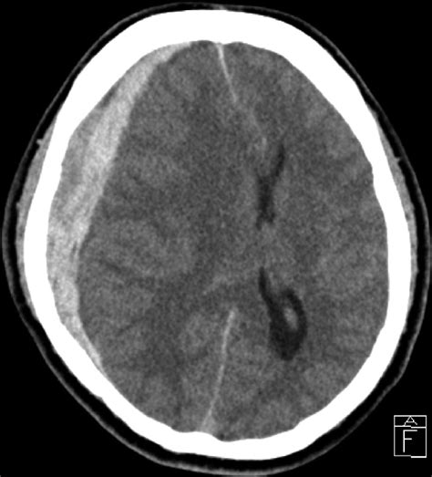 Subdural Hemorrhage CT Scan