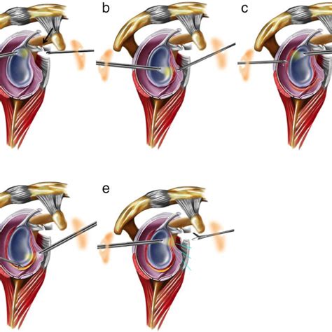 Arthrogram of the shoulder being performed for the MRI scan. | Download ...