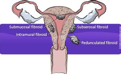 Myomectomy: This surgical procedure removes problematic fibroids from ...