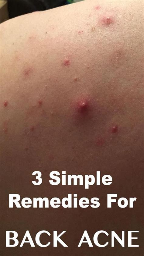 3 Best Remedies For Back Acne in 2020 | Back acne remedies, Acne, Body acne