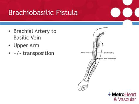 Ppt Arteriovenous Fistulas Types Trends Physical Examination ...