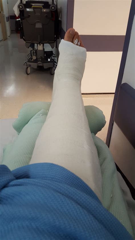 The day I broke my leg - broken tibia and fibula with intramedullary nail