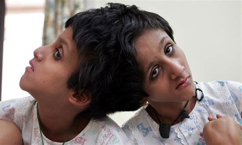 'Allow them to die': The heart-breaking plea of Siamese twins' father ...