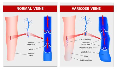 Varicose Veins Causes and Complications - Healthy Skin Care