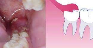 Tooth Abscess Problem Question, Wisdom Teeth Problems Chatting, Dental ...