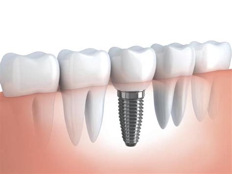 Dental Cement – Types, Functions, Features & Benefits