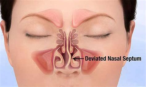 How To Cure A Deviated Septum - Treatmentstop21