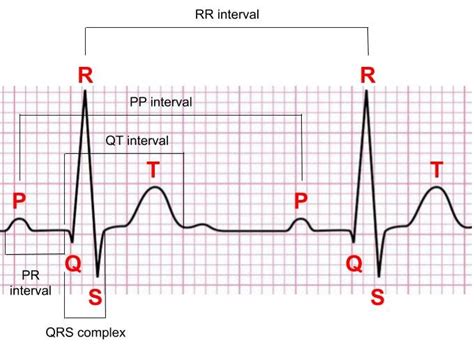 Normal Sinus Rhythm