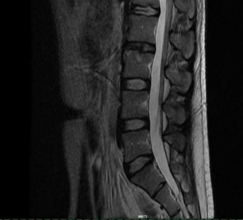 MRI Results. Any advice? : r/Sciatica