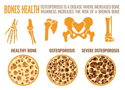 Decrease the Risk of Osteoporosis with Exercise - Propel Physiotherapy