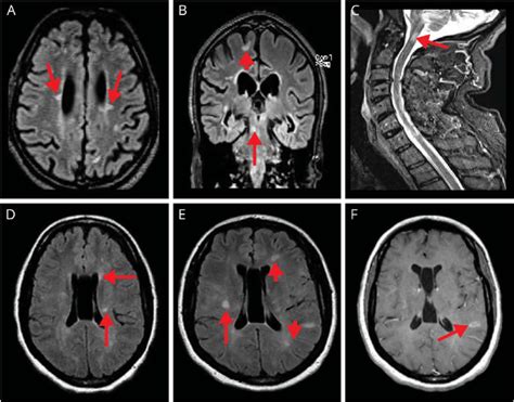 Examples of typical MS MRI findings | Download Scientific Diagram