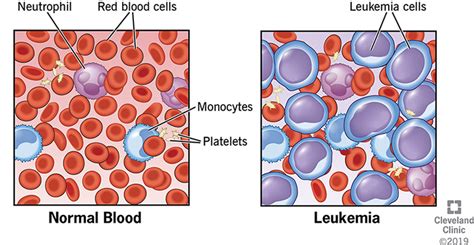 Leukemia: Symptoms, Signs, Causes, Types & Treatment