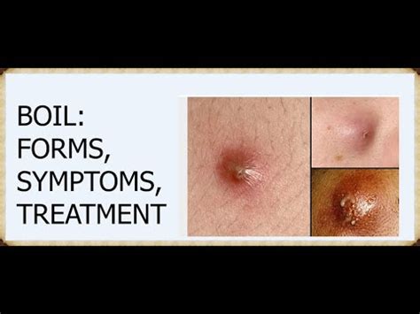 What Is a Boil,FORMS,SYMPTOMS,TREATMENT - YouTube