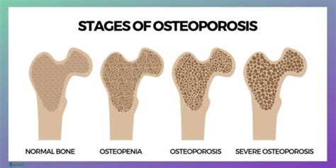 OSTEOPENIA - Symptoms, Causes, Risk Groups, Prevention and Treatment ...