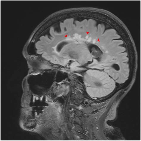 Multiple Sclerosis Mri Dawsons Fingers