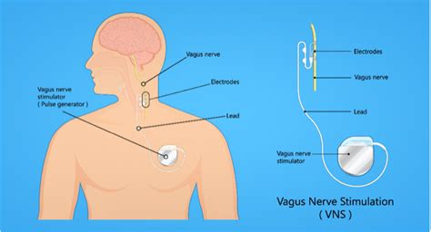 Vagus Nerve Stimulation (VNS) - NCMD