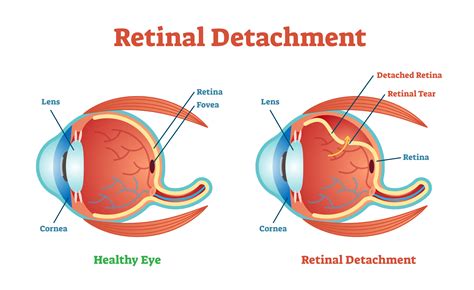 Retinal Detachment Oct