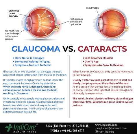 Cataracts Is an Eye Condition Best Described as - ZanderkruwWatson