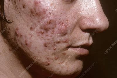 Nodular acne - Stock Image - C038/4489 - Science Photo Library