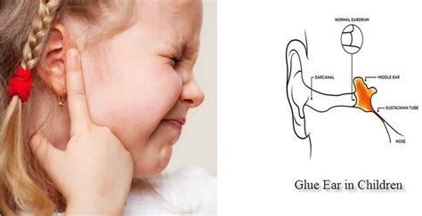 Glue ear causes, symptoms, diagnosis, treatment & prognosis