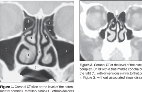 Figure 3 from THE ROLE OF OSTEOMEATAL COMPLEX ANATOMICAL VARIANTS IN ...