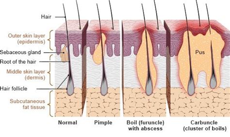 How are boils treated? | informedhealth.org