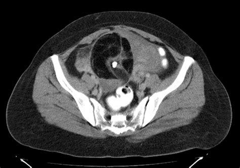 Radiodiagnosis - Imaging is Amazing-Interesting cases: Ovarian Dermoid - CT