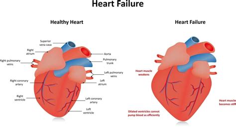 Heart Failure - familydoctor.org