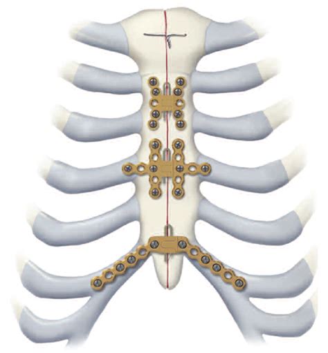 MRI safety: sternal wires - Questions and Answers in MRI