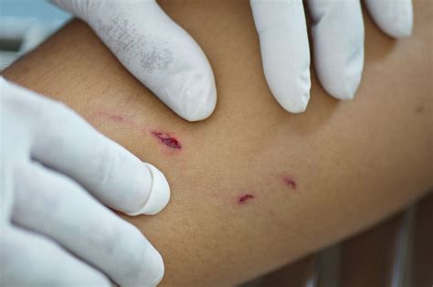 Wound Care and Treatment After a Dog or Animal Bite