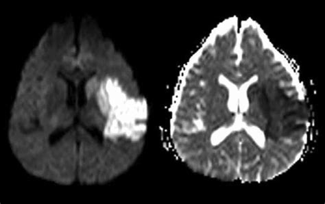 Restricted diffusion with increased diffusion-weighted imaging and low ...