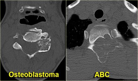 RadiologySpirit: osteoblastoma