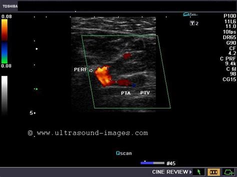 Incompetent perforators in a case of varicose veins: ~ Ultrasound Cases ...