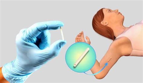 Understanding The Removal Of Subdermal Contraceptive Implant