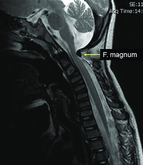 Foramen magnum and spinal cord narrowing were detected by MRI in 2004 ...