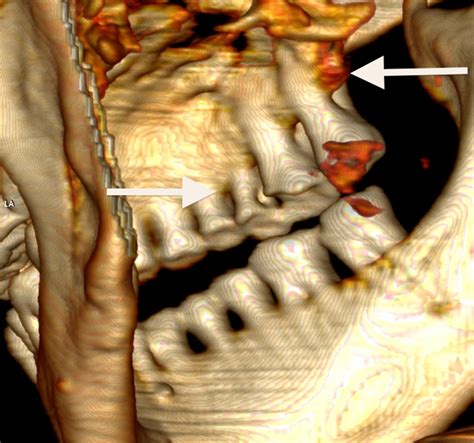 Iceman Mummy Had Bad Teeth | Otzi | Live Science